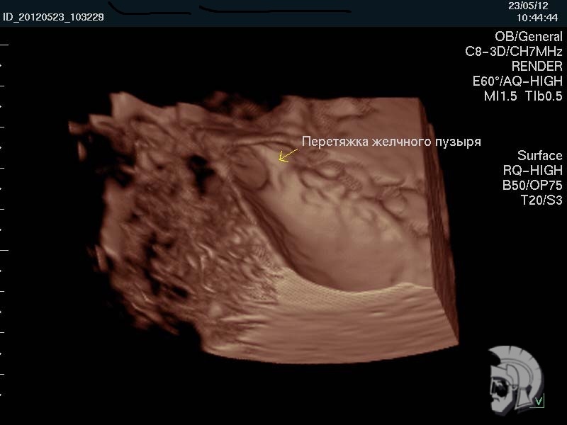 Тот же случай. 3D-реконструкция желчного пузыря