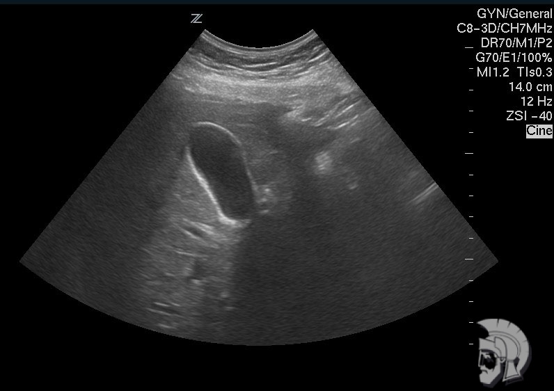 Крупный (переполненный желчью) желчный пузырь мужчины 40 лет с дискенизией желчевыводящих путей по гипотоническому типу
