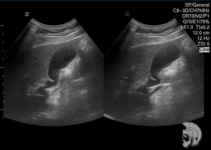 Желчный пузырь