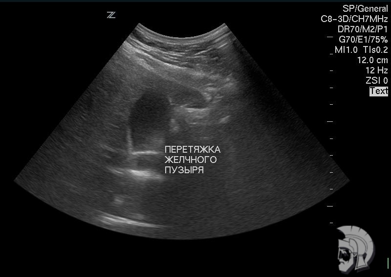 Желчный пузырь с перетяжкой