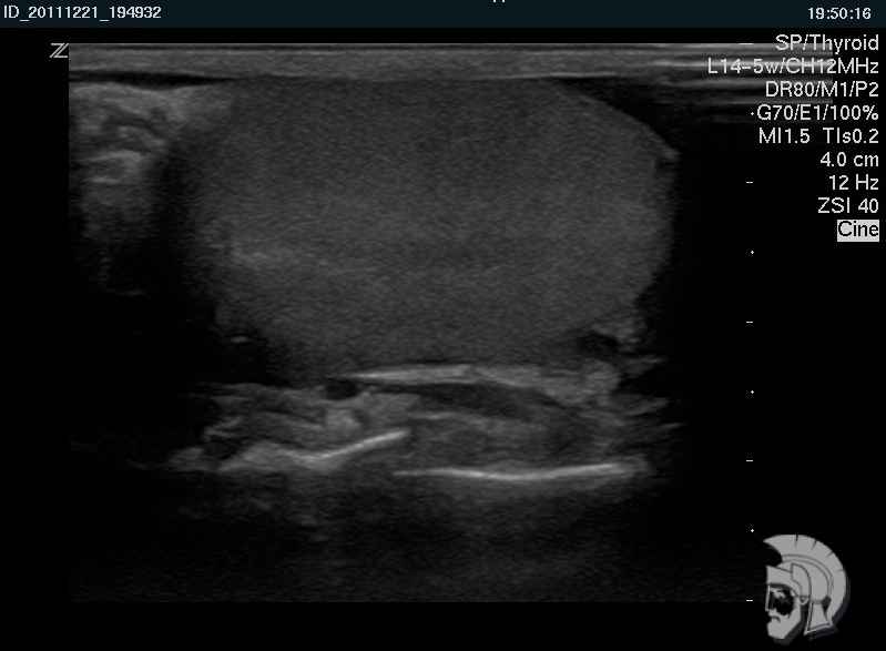 Нормальная эхо-структура яичка
