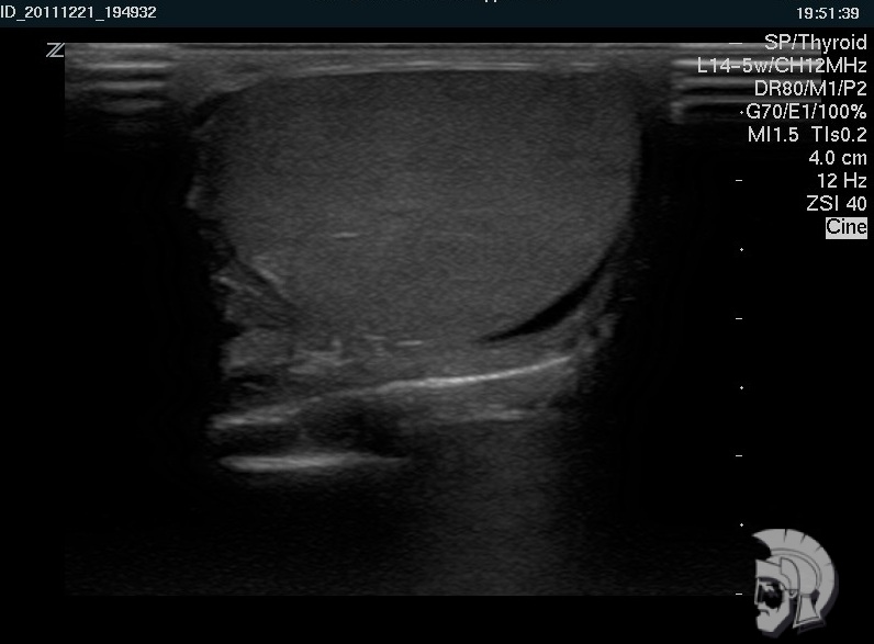 Нормальная эхо-структура яичка