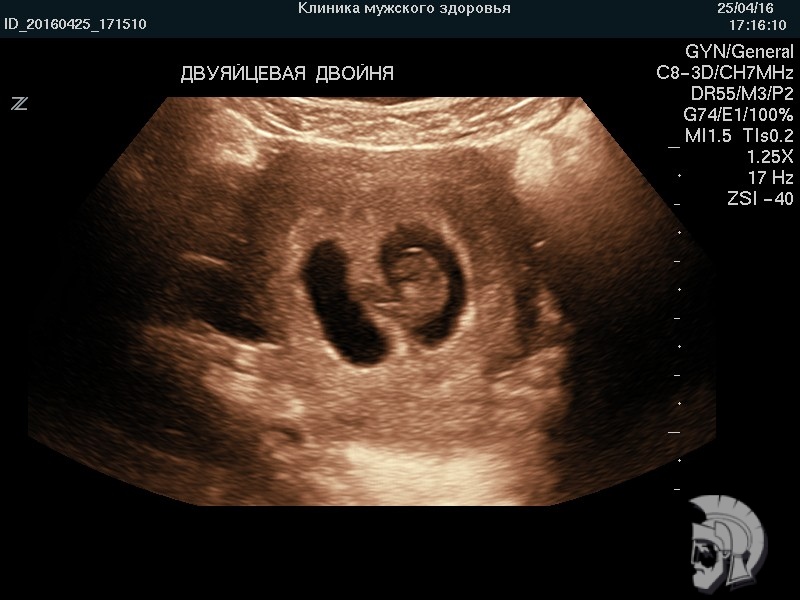 Фото беременности. Двуяйцевая двойня в сроке 7 недель