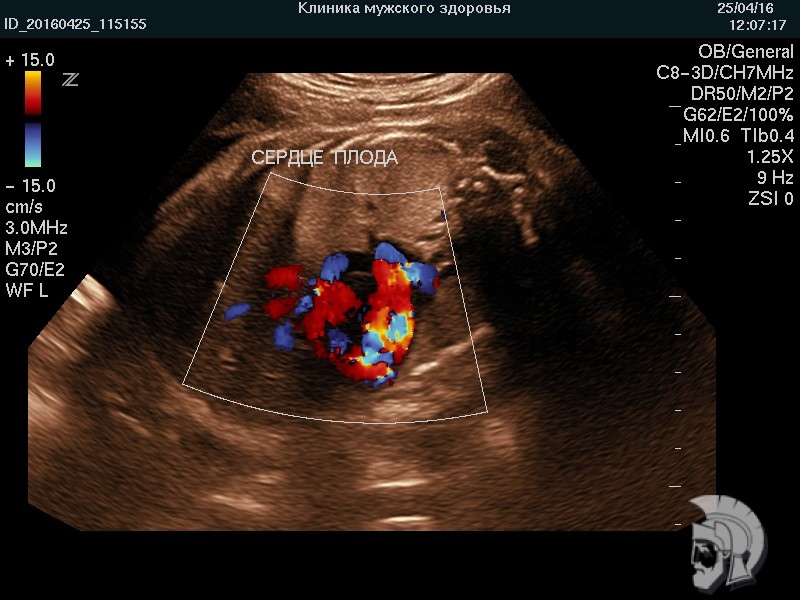 Фото беременности. Сердце плода 20 недель. Исследование структуры сердца в режиме цветового допплера