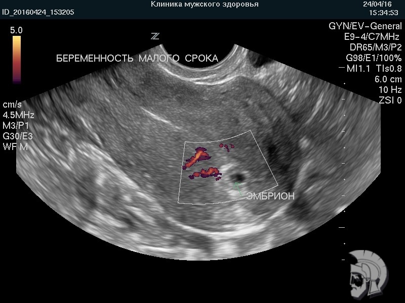 Фото беременности малого срока. Эмбрион в виде пшеничного зерна указан стрелкой. При исследовании в режиме допплера определяется маточный кровоток