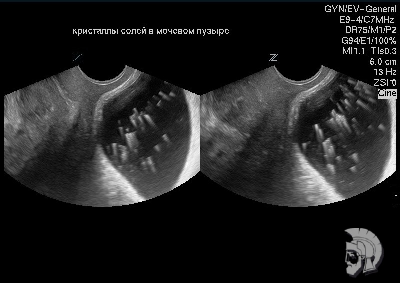 Кристалы солей в мочевом пузыре