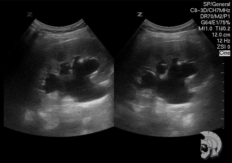 Пиелоэктазия. Расширение чашечно-лоханочной системы левой почки беременной в сроке 24 недели