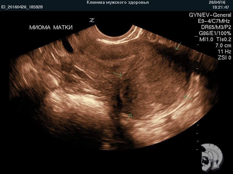 Фото миомы матки. Крупный интерстициальный (межмышечный) узел в дне матки, деформирующий контур задней стенки