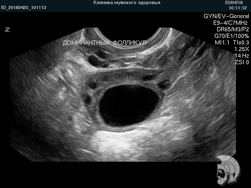 Фото фолликулометрии. Созревший (преовуляторный) фолликул в яичнике указан стрелками