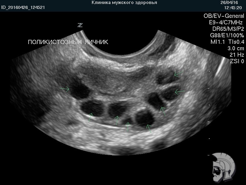 Фото поликистозного яичника. Множественные мелкие фолликулы («кисты») указаны стрелками