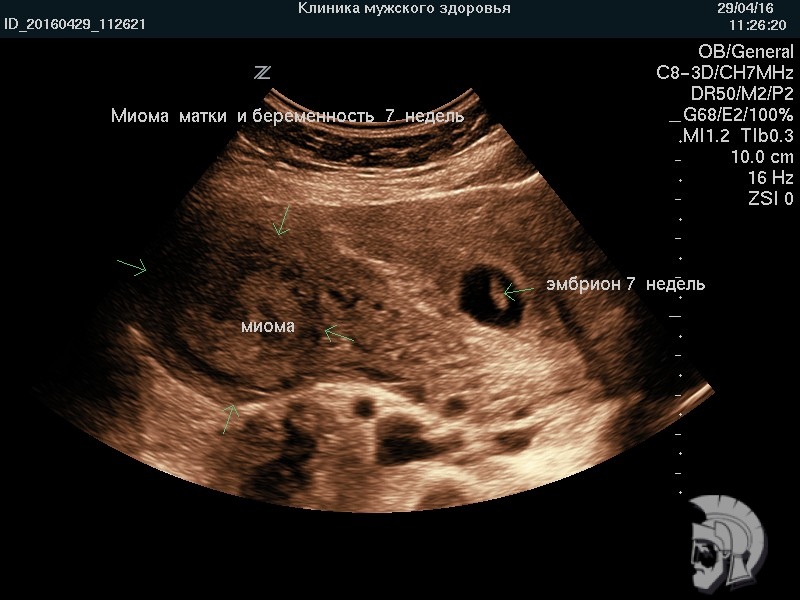 Фото миомы матки и беременности 7 недель