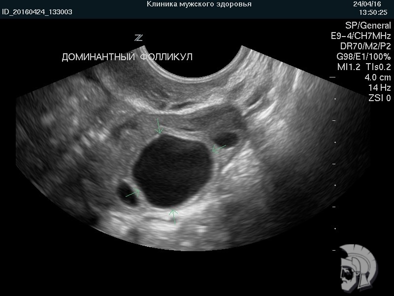 Фото фолликулометрии. Наиболее крупный фолликул (доминантный фолликул) указан стрелками