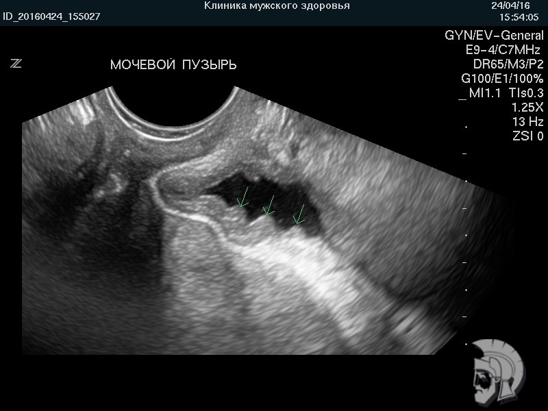 Фото мочевого пузыря нетугого наполнения. Складки слизистой оболочки мочевого пузыря